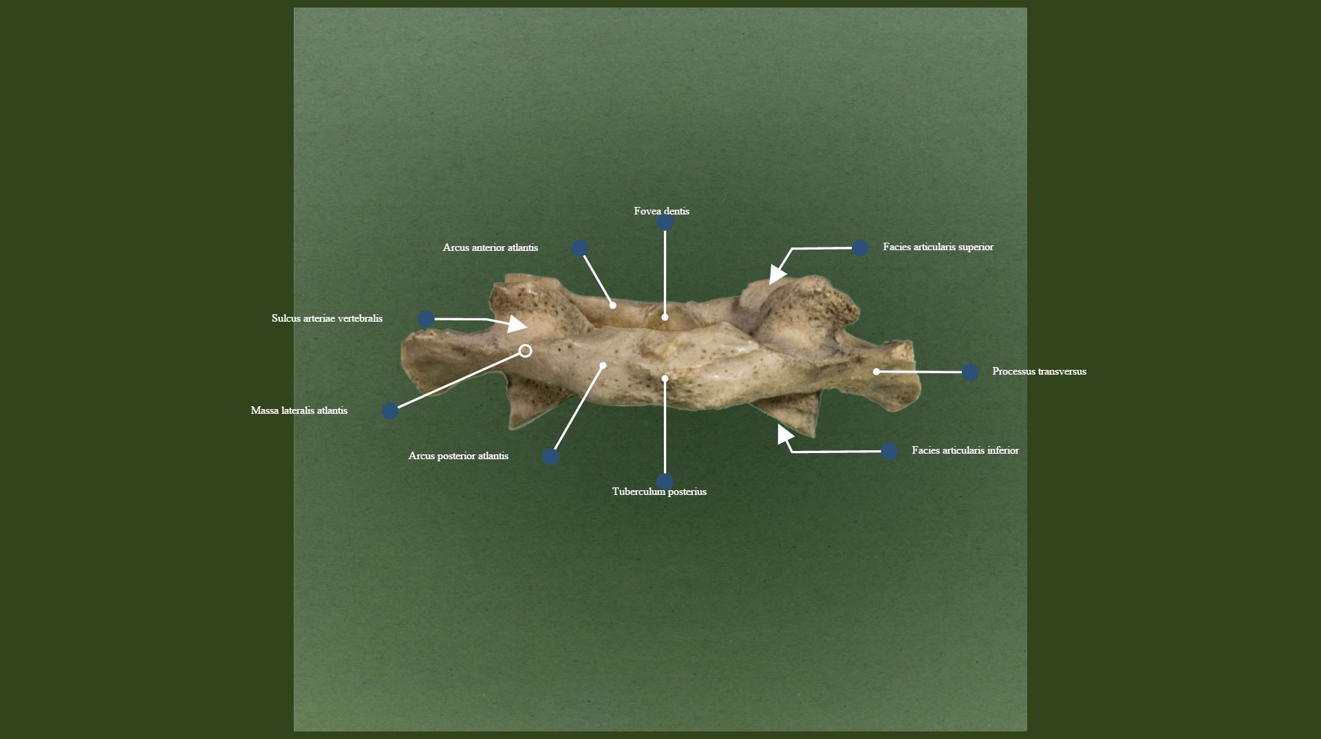 An Atlas Of Human Anatomy For Students And Physicians Anatomy Lateral Mass Massa Lateralis Anterior Arch Arcus Anterior Anterior Tubercle Tuberculum Anterius Fig 53 The Atlas Or First Cervical Vertebra Seen From